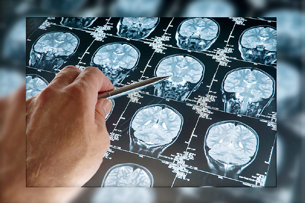 Vital Breakthrough in Brain Cancer Detection